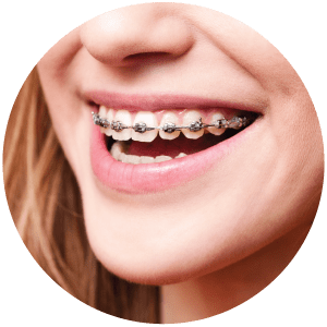 Young girl wearing braces in Everett WA