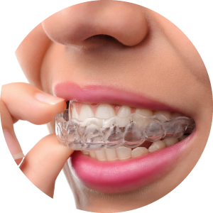 A woman putting in her Invisalign aligners